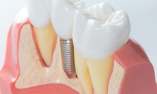 იმპლანტოლოგია