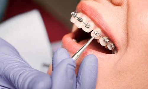 Close up of dentist hand in serial glove putting elastic rubber band on patient brackets. Woman with wired metal braces on teeth receiving orthodontic treatment in dental clinic. Concept of dentistry.